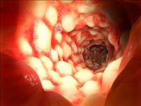 Colitis Disease